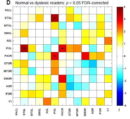 Groepsverschil in functionele connectiviteit Minder efficiënte communicatie tussen Broca en bilaterale auditieve cortex Individuele verschillen in sterkte van deze FC zijn