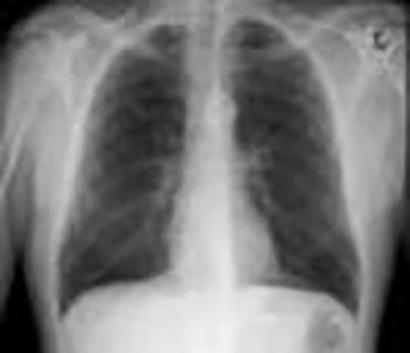 Met röntgen-ct zijn bovendien verschillende soorten weefsels zichtbaar te maken: longen, beenderen, zachte weefsels en bloedvaten.