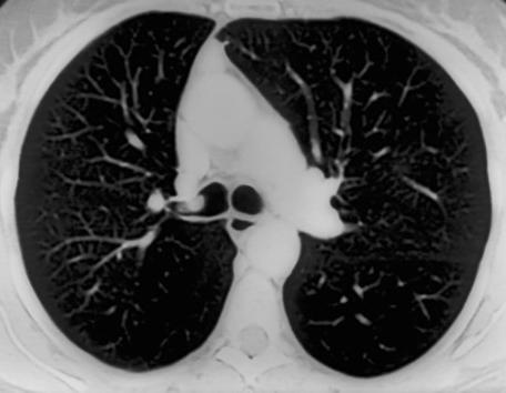 Rechts: dwarsdoorsnede van de longen na een CT-scan.