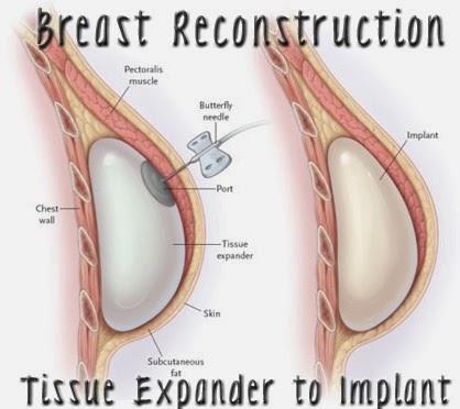 Borstreconstructie door weefseloprekking (met tissue expander) In deze folder geven wij u informatie over de borstreconstructie met behulp van een tissue expander.
