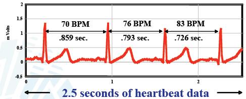 dispersion (echocardio): toont ook vervorming op bepaalde echo s igv onregelmatig: ook maat om fibrose in te schatten repolarisatie o QT-lengte en -dispersie langer = slechter dispersie: QT-tijd in