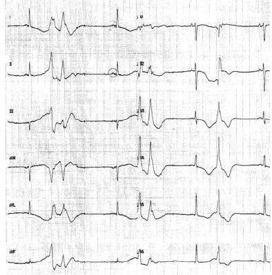 continu ECG monitoring ICD standby! stoppen als er belangrijke ECG-afwijkingen ontstaan: conductievertragingen (AVB) o sotalol (w bijna nooit gedaan!) nut: kijken of er tolerantie is (QT-verlenging?