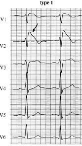 o DCMP o VKF ECG o type 1 onvolledig RBTB coved ST-optrekking 2 mm met