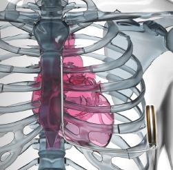 bradycardie sensing en pacing antitachycardie pacing o iedere defibrillator is pacemaker maar niet iedere PM is defibrillator uitz: subcutane defibrillator is géén PM subcutane defibrillatoren: