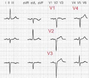 afleiding I pathologisch want 1 mm breed en 3