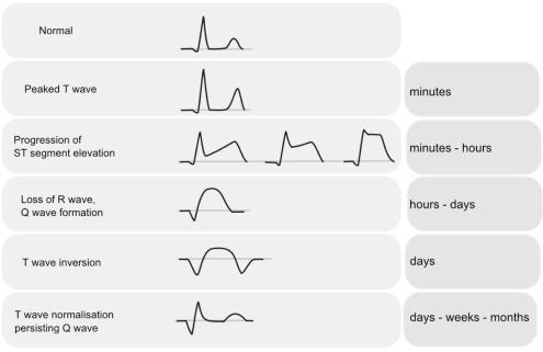 o QS na R bij meer uitgebreide necrose: vetraagde R-progressie gaat zelfs over in abnormale Q-golven Natuurlijk verloop myocardinfarct acute fase = eerste uren o zeer spitse hoge T o ST-segment