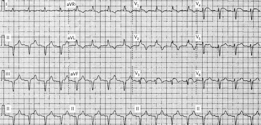 geleidingssysteem dus NIETS te maken met vagale tonus bijna altijd obv proximale occlusie LAD met septale necrose o site conductievertraging: geleidingssysteem distaal vd AV-knoop (His-Purkinje)