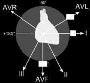 repolarisatiestoornissen ziet in V6, dan moet je ook iets zien in V5 anders mss eerder artefact igv noodzakelijk: bijkomende afleidingen in horizontale vlak kunnen opgenomen w o V3R V6R =