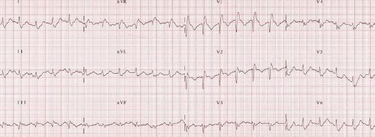 ! o acuut longembool acute dilatatie vd RV + posterior rotatie vh hart criteria RV hypertrofie aanwezig acute RV dilatatie produceert posterior
