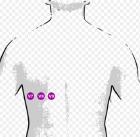 !: DD van grote R in V1 (+ hoe ze te differentiëren) o posterior infarct ST-depressie en T-elevatie in V 1 en V 2 Q-golven en ST-elevatie in V 7 V