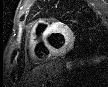 (inspanningsgerelateerde) dyspnoe thoracale pijn in rust of bij inspanning hartfalen palpitaties: VKF, premature extra slagen, nsvt syncope hypovolemie compleet AV block sinusknoopdysfunctie