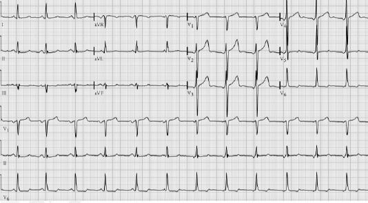 medicatie katheterablatie ICD s o brady-tachy-aritmie = eigenlijk niet eigen categorie maar mengvorm Sinusritme sinusritme: 60 100/min o sinusbrady: < 60 bpm vanuit sinusknoop o sinustachycardie: >