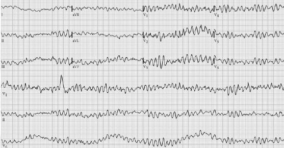 chaotische activatie ventrikels zonder discrete QRS-complexen initieel