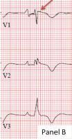 oorzaak SCD o diagnose 80% ptn hebben abnormaal ECG meer ECG afwijkingen = ernstigere ziekte T-golf inversie (TWI) in anterior precordialen V1-V3 zonder RBTB heel belangrijk!