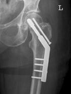 Dynamic Hip Screw Een DHS bestaat uit twee componenten. Een stevige schroef die vanaf de zijkant van de heup wordt ingebracht en een plaatje die aan het dijbeen wordt vastgemaakt.