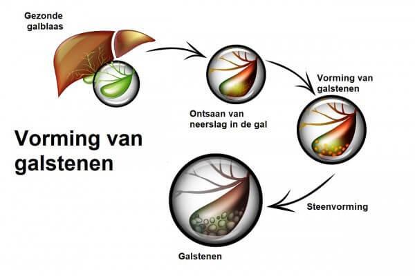 8. Galstenen & cholescystitis Galstenen zijn stenen die in de galblaas worden gevormd. De aanwezigheid van galstenen in de galblaas wordt cholelithiasis genoemd.