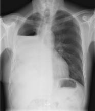 Postoperatieve complicaties * Atelectase - mucus impactie - pneumonia * Arythmie (25%) * Broncho-pleurale fistel * Empyeem * Verlengd luchtlek Postpneumonectomie empyeem :levensbedreigend Etter in