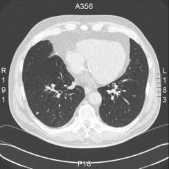Symptomen op moment diagose longkanker - 1/3 : Symptomen van metastasen - 1/3 : Asymptomatisch (toevallige