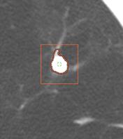 Multidetector CT scan : sneden van 1 mm in one single breath (5 sec) lage radioactieve straling Hoge