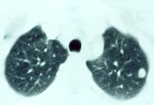 Verdubbelingstijd M+ Histologie Kiemcel : best Melanoma : slechtst Mediastinale