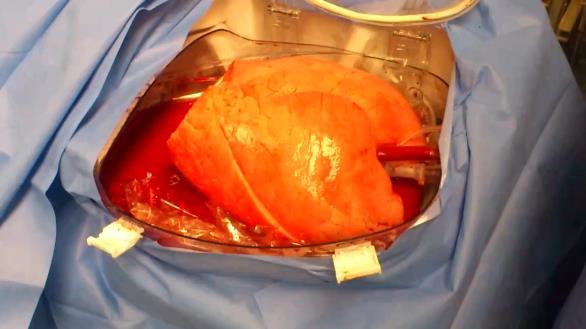 Transplant Int 2015; 28: 643-56 Topics longkanker