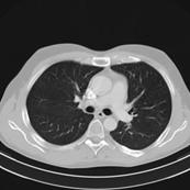 Tepper/Tiddens: Relatie CT-scans longen en kwaliteit van leven Pierluigi Ciet/Tiddens: Vergelijking