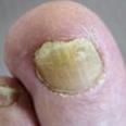 Dia 16 Onychokeratose / Hyperkeratose subunguinalis (kalknagel) (verdikking) van de nagel.