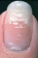Dia 22 Witte vlekjes in de nagel / leuconychia Oorzaak beschadiging van de nagelriem stofwisselingsziekte nierziekten Infecties, vergiftiging, trauma