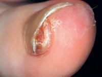 22 Dia 23 Exostose onder de nagel / exostose subungualis Bot- of kraakbeen woekering onder de nagel Een rood plekje onder de nagel, de nagel kan wat