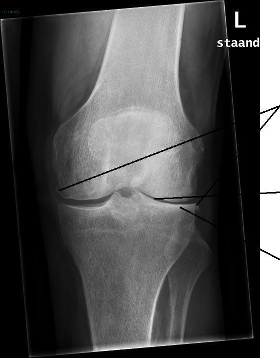 Doordat de knie door zijn functie en bouw één van de zwaarst belaste gewrichten in het lichaam is, komt artrose van de grote gewrichten het meest in de knie voor.