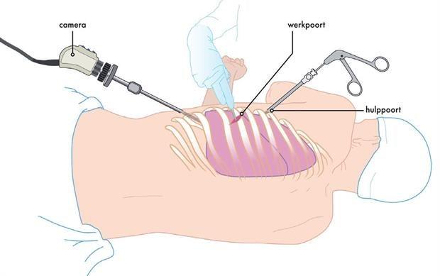 Selectie van de optimale benadering Subxiphoidaal Intercostaal Pericardioscentese