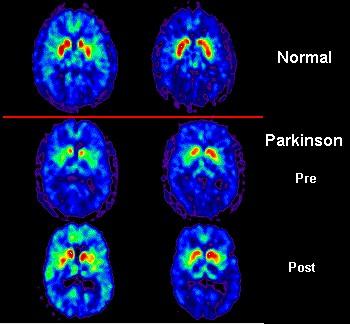 Ziekte van Parkinson Gevolg van sterke degeneratie van de dopamineneuronen in de substantia nigra Degeneratie