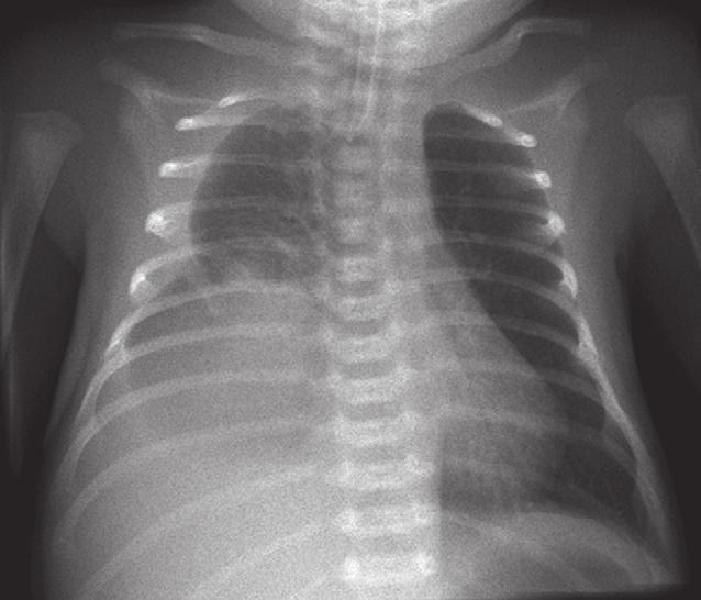 beschaduwing rechts basaal pleuravocht linker diafragmakoepel figuur 3. Thoraxfoto bij heropname van patiënt A wegens recidiverende tachypneu en dyspneu.