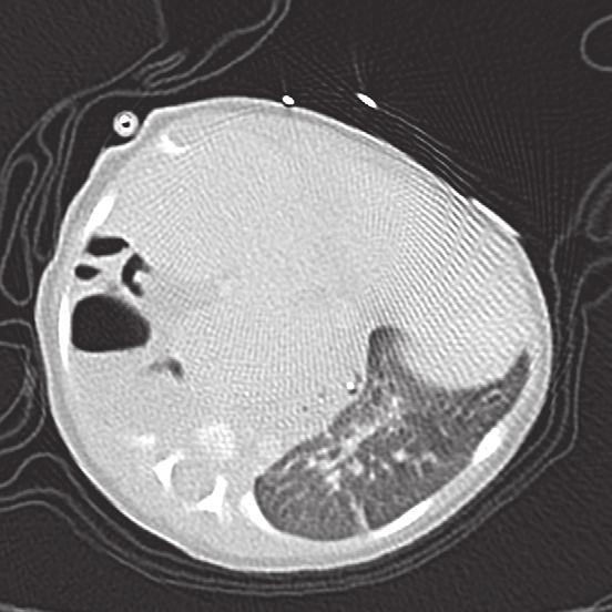 a b lucht in darmlissen maag darmlissen in rechter thoraxholte leverkwab corpus vertebrae, ter hoogte van diafragma