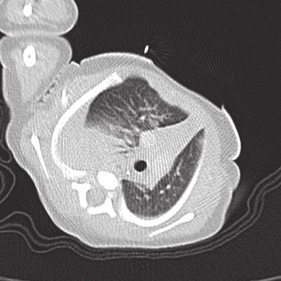 trachea c figuur 4. CT-scan van de thorax van patiënt A.