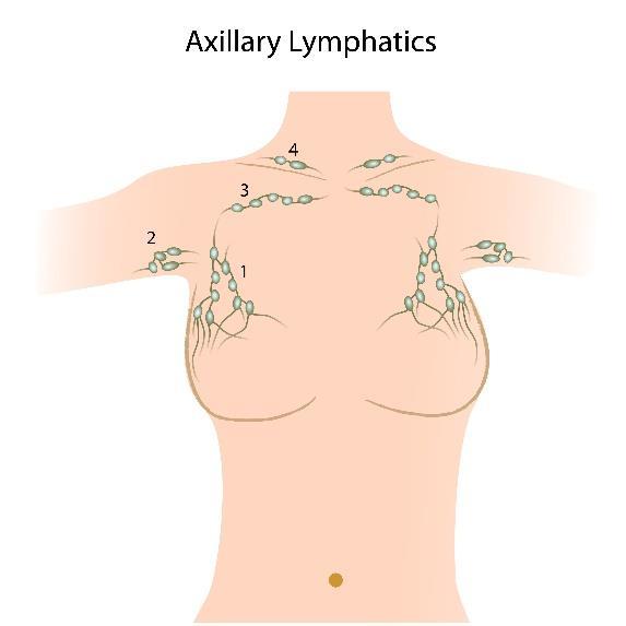 Inleiding De borstkanker is bij u uitgezaaid naar de lymfeklieren. Er is met u overlegd dat de lymfeklieren uit de oksel worden verwijderd. Deze operatie noemt men okselklieroperatie.