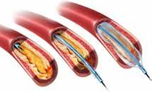 Het onderzoek Een coronarografie is een onderzoek waarbij via de slagader een buisje wordt geplaatst (catheter).