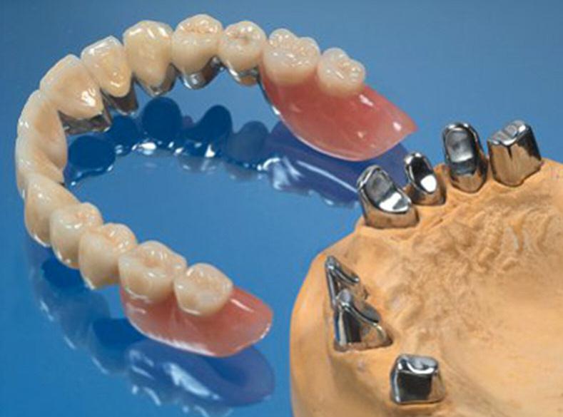 TELESCOOPPROTHESE Wanneer er meerdere tanden afwezig zijn en een brug niet meer mogelijk is, dan zoekt u een goede oplossing. Vele denken dan aan een plaatje of frame prothese, als enige oplossing.