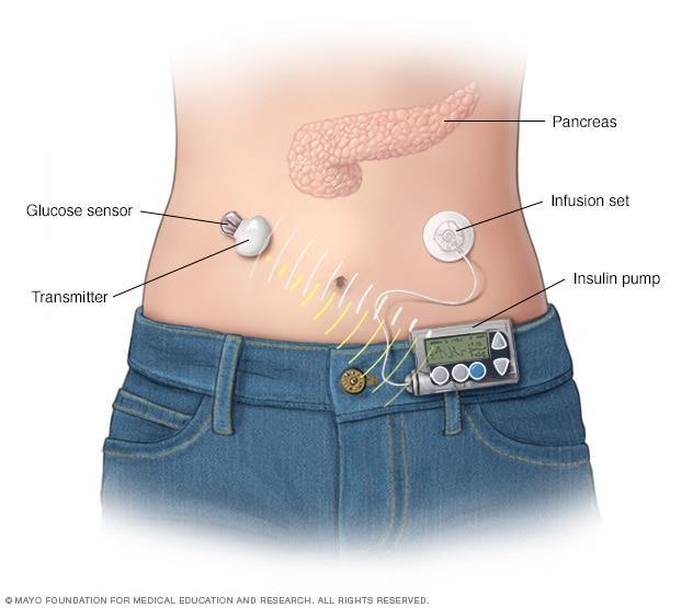 sensor in onderhuids vetweefsel Gemeten glc via