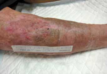 De ODS werd nog twee weken volgens advies leverancier op het gesloten huiddefect geplaatst ter versteviging van de huid ter plaatse (foto 7).