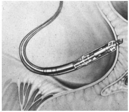 In 1993, beschreef Pibarot et al. de implantatie van een dual-chamber pacemaker bij een ezel met een complete derdegraads AV-blok.