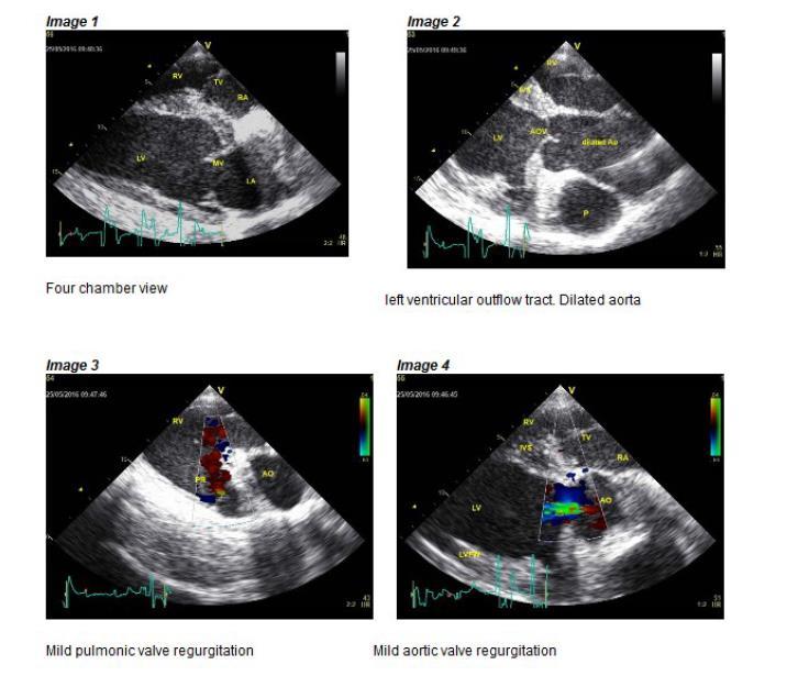 Afbeelding 8: echocardiografische opnames van het hart via de rechterkant (transducer 6 mhz) 1: vier kamer beeld; 2: gedilateerde aorta; 3: milde pulmonaal klep regurgitatie; 4: milde aorta klep