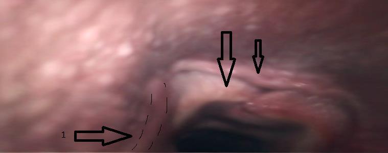 Afbeelding 10: Endoscopische opname tijdens de dynamische endoscopie op de piste in draf. De plica aryepiglottica wordt aangezogen in de trachea (1) (Kliniek Inwendige Ziekten van de Grote Huisdieren.