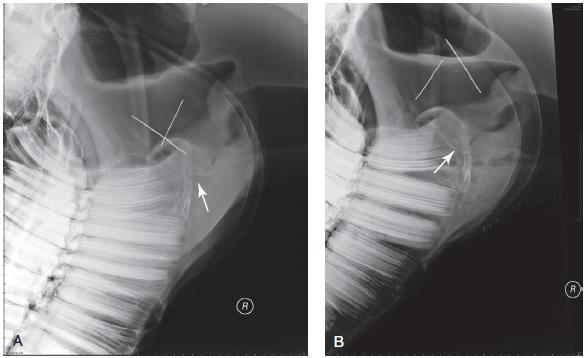 Afbeelding 14: Laterale radiografieen voor (A) en na (B) een tie-forward chirurgie bij een paard met DDSP uit Ducharme (2012).