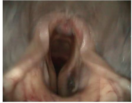 Afbeelding 15 uit Fjordbakk et al. (2015) : Endoscopisch beeld tijdens een onderzoek op de loopband van een paard gediagnosticeerd met DLC tijdens flexie van de nek.