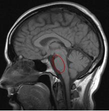 Locked-in syndroom Ventrale deel van de stam (pons) Infarct-bloeding-trauma Intact