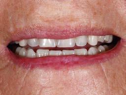 tandtechnische ervaring een prothesetand nodig die ontwikkeld werd op basis van de natuurlijke esthetisch-functionele regels.