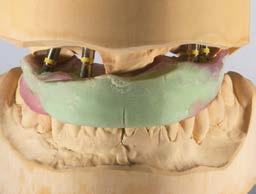 3 Bij een kunststofduplicaat van de tandkrans van de oude prothese werd een wax-up uitgevoerd om de nieuwe gewenste situatie te definiëren. Afb.