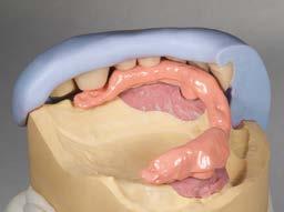 Voor een zo natuurlijk mogelijke en levendige optiek kon de prothese vervolgens met VITA VM LC flow micropartikel-composiet (GINGIVA 1; oudroze en GINGIVA 3; roze) en