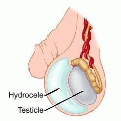 GOEDAARDIGE ZWELLING VAN HET SCROTUM Hydrocoele Een hydrocoele is een goedaardige zwelling van het scrotum (balzak), die soms vrij grote proporties kan aannemen tot en met 15 cm.